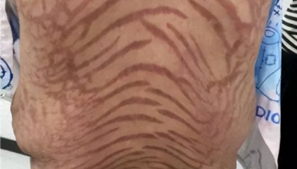 触目惊心，女子涂了10年“网红药”，全身长满“蛇纹”，彻底傻眼