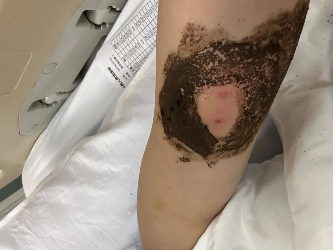 4名游客景区内遭马蜂袭击，旅游度假区：是森林公园不卖门票，蜇伤先就医后提供证据投诉