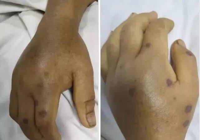 深圳一市民突遭马蜂围袭！已进入高发期，千万别招惹！