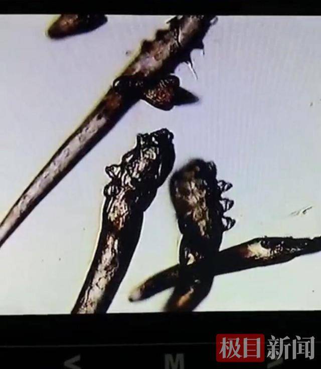 11岁女孩眼痒眼痛，竟是睫毛“养了”10条螨虫！医生：不良生活习惯是帮凶